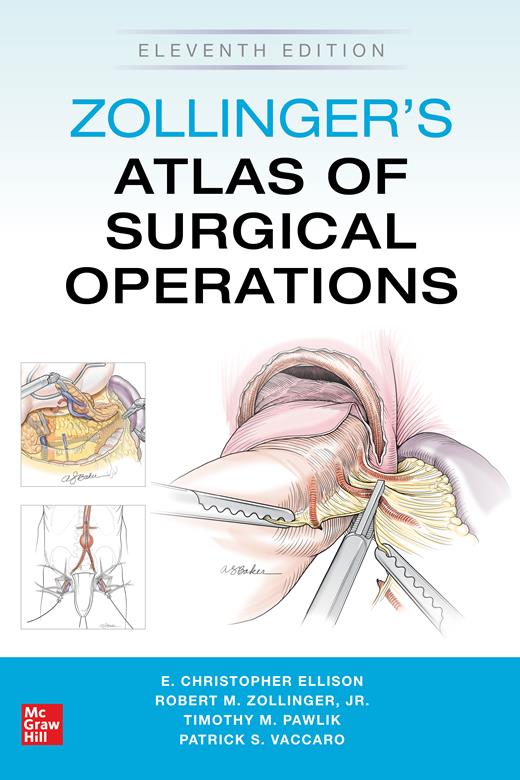 Gastrectomy, Polya Method | Zollinger’s Atlas of Surgical Operations ...