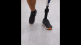 Excessive Toe-Out Angle | AccessPhysiotherapy | McGraw Hill Medical
